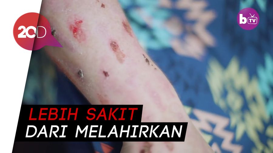 Penyakit Langka Bikin Tubuh Wanita Ini Seperti Terbakar