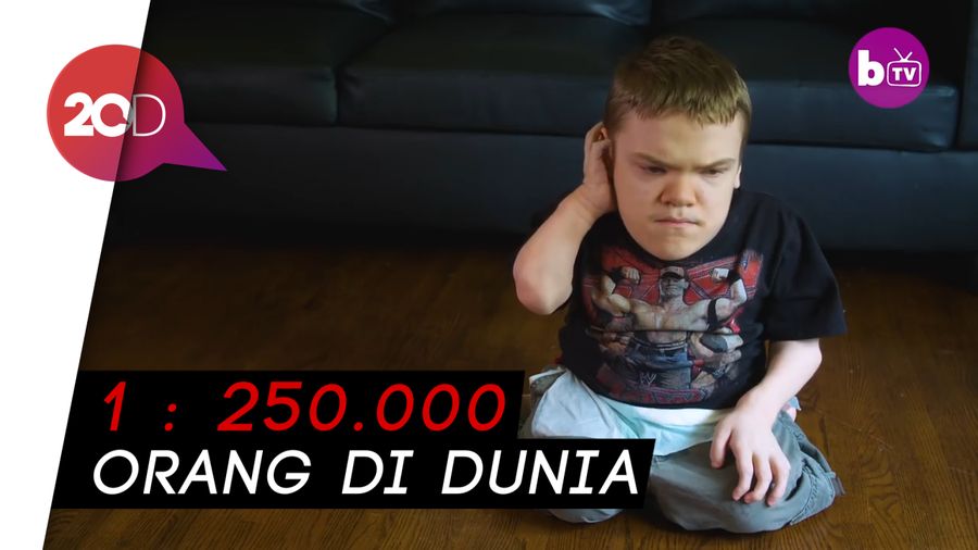 Penyakit Langka Bikin Pria Ini Terlihat Seperti Balita