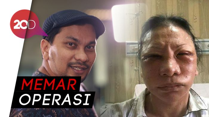 Komentari Muka Ratna Sarumpaet Bengkak, Tompi: Gilaaaa!