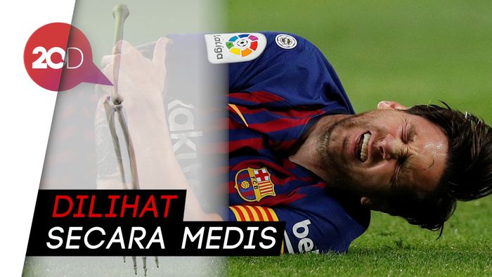 Tulang Radial Messi Patah, di Mana Letaknya? 