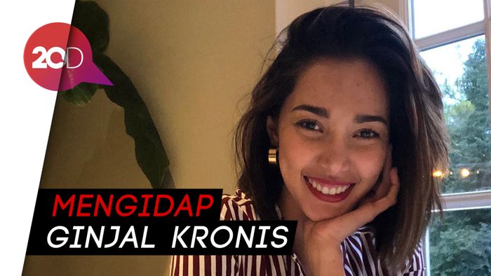 Help! Mantan Miss Internasional Ini Butuh Transplantasi Ginjal