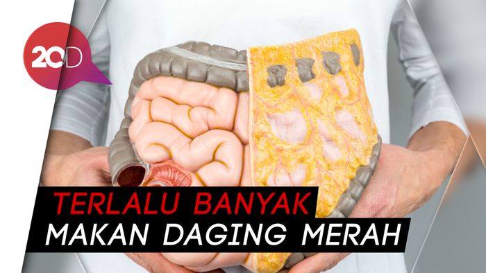 Mengenal Faktor Risiko Kanker Usus