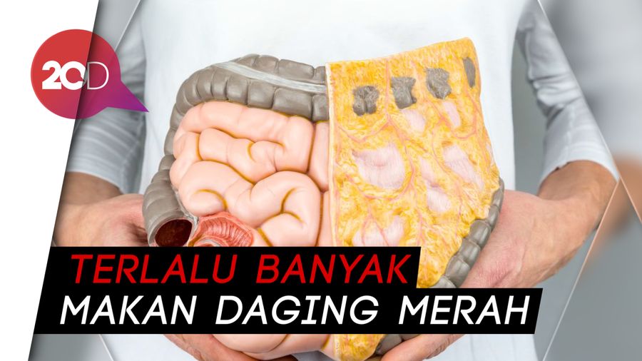 Mengenal Faktor Risiko Kanker Usus