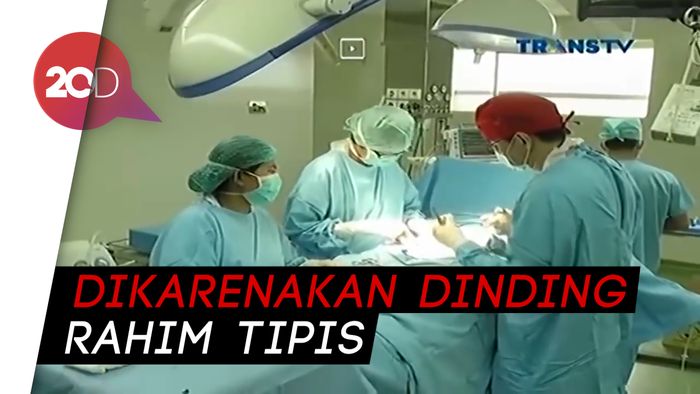 Melihat Proses Melahirkan dengan Operasi Caesar