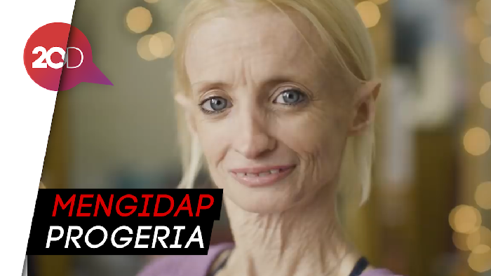 Idap Penyakit Langka, Wanita Ini Menua dengan Cepat