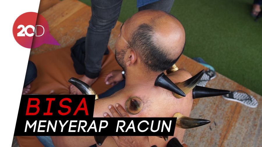 Bekam Tanduk Sapi, Pengobatan Terapi Alami yang Istimewa