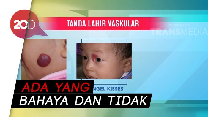 Yuk, Mengenal Macam-macam Tanda Lahir pada Bayi!