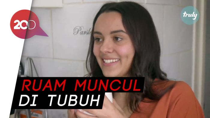 Wanita Ini Mendadak Alergi Air Usai Melahirkan
