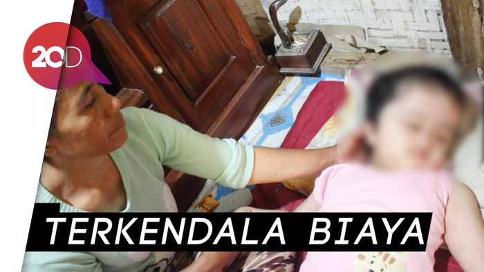Tolong! Bocah Hidrosefalus di Bandung Butuh Uluran Tangan
