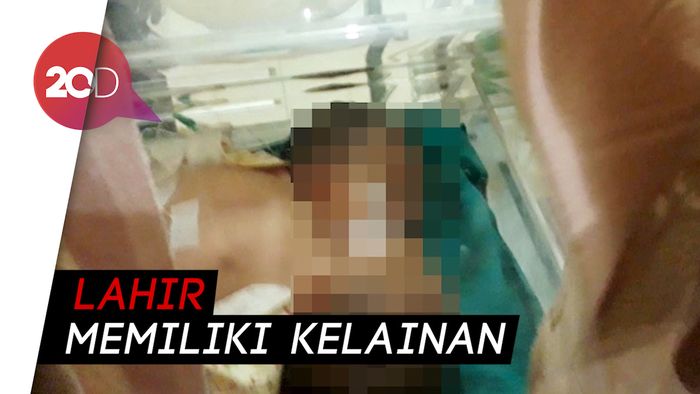 Bayi Berkepala Dua di Brebes Meninggal Dunia