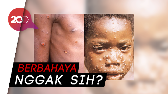 Imbauan Kemenkes RI soal Cacar Monyet yang Gemparkan Singapura