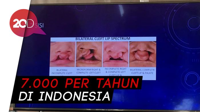 Pasien Bibir Sumbing Terbanyak Ada di Sumut dan Kalimantan