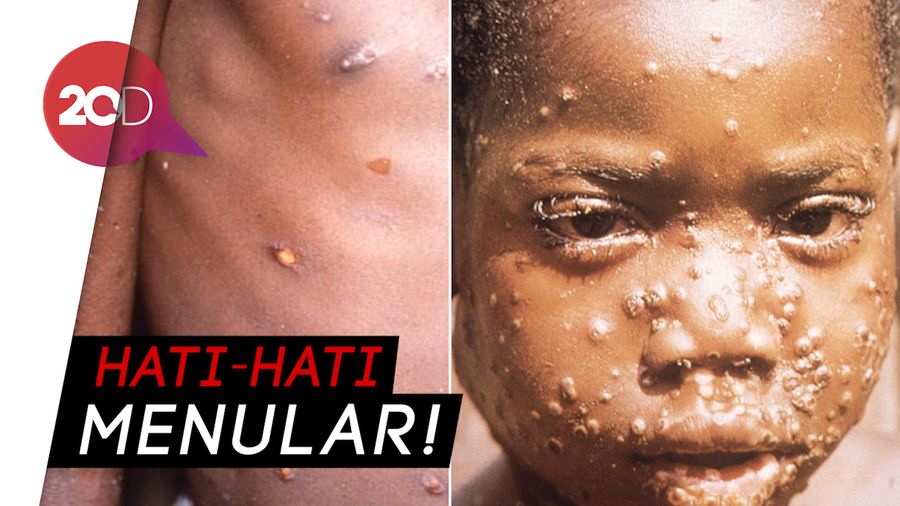 Kenali Gejala dan Waspada Cacar Monyet