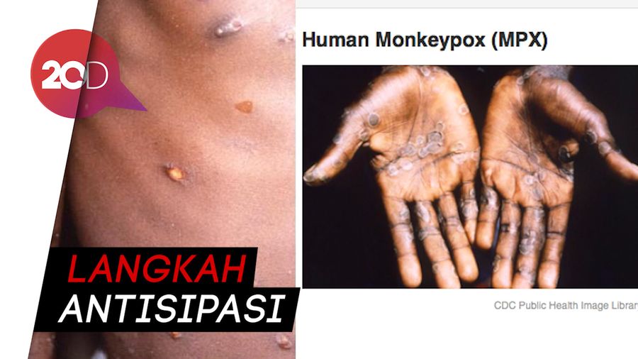 Waspadai Cacar Monyet, Menkes Tekankan Kebersihan