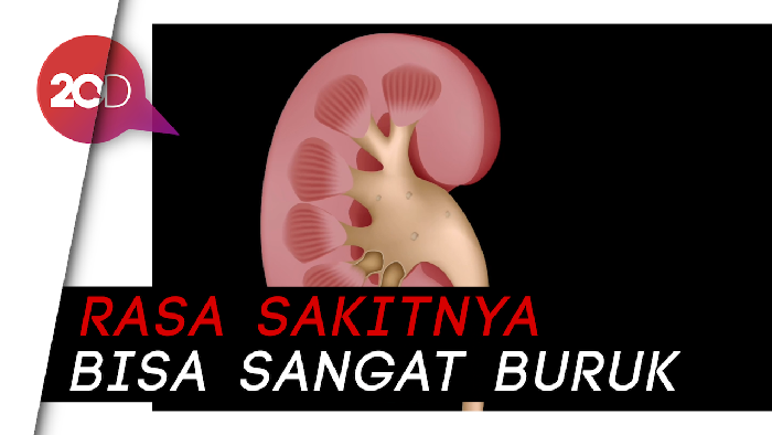 Fakta-fakta Seputar Batu Ginjal yang Diidap Dorce Gamalama
