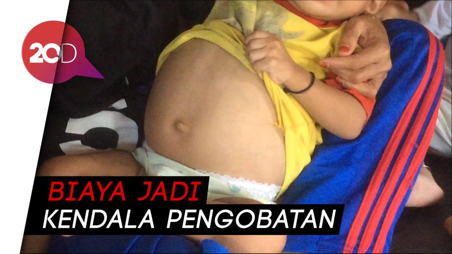 Malang Nian Nasib Balita Rifki, Perutnya Membesar Bak Ibu Hamil