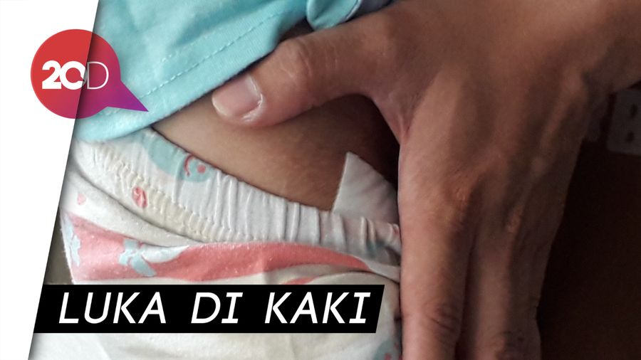 Bocah Asal Sleman Digigit 2 Anjing di Vila