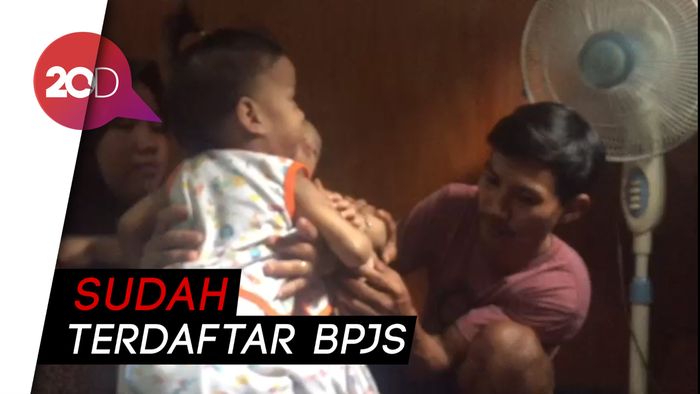 BPJS Kendari Klaim Cover Biaya Operasi Bayi Kembar Siam
