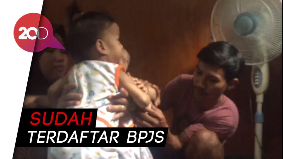 BPJS Kendari Klaim Cover Biaya Operasi Bayi Kembar Siam