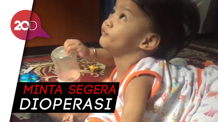 Bayi Kembar Siam dari Kendari Butuh UIuran Tangan