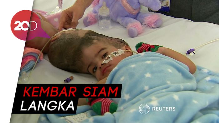 Operasi 55 Jam, Kembar Siam Pakistan Berhasil Dipisahkan