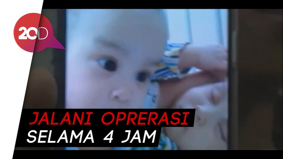 Akhirnya Bayi Kembar Siam Adam & Malik Berhasil Dipisahkan