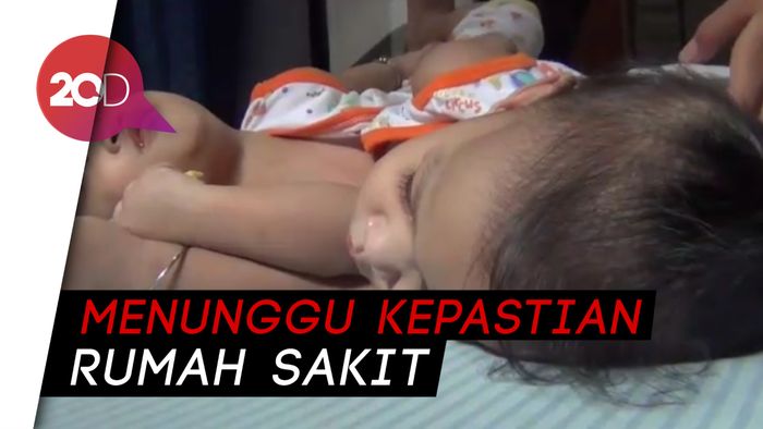 Balita Kembar Siam di Kendari Ini Butuh Operasi Pemisahan