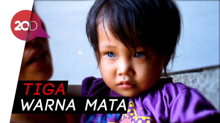 Amelia, Balita yang Bola Mata dan Rambutnya Berubah-ubah Warna