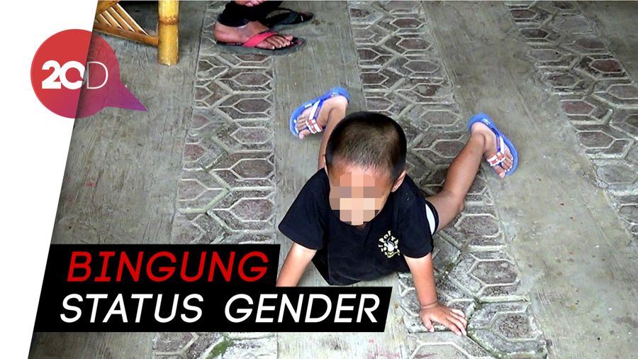 Anaknya Berkelamin Ganda, Ortu tak Punya Biaya Berobat