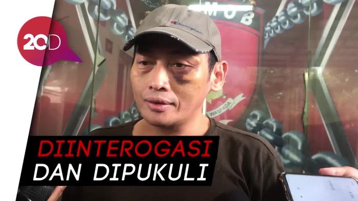 Wajah Masih Lebam, Ninoy Karundeng Bicara Penganiayaan yang Dialami