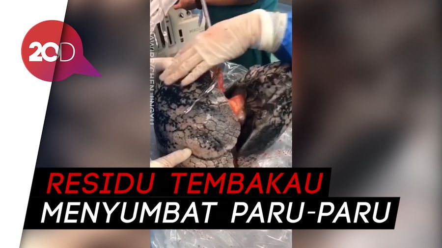 Viral Video Paru-paru Jadi Hitam karena Merokok Puluhan Tahun