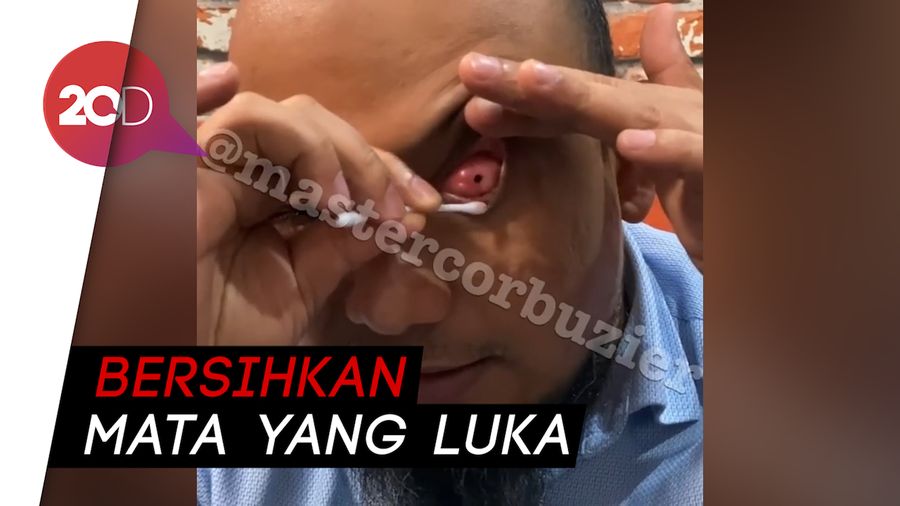Novel Baswedan Tunjukkan Luka di Mata Kirinya Bukan Rekayasa