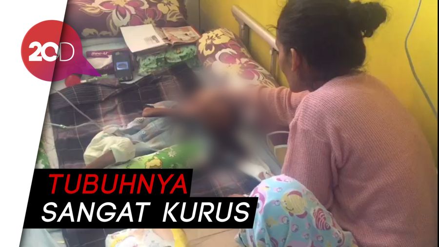 Tolong! Balita di Buton Mengidap TBC dan Gizi Buruk