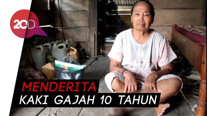 Tolong! Nenek di Mamuju Sebatang Kara dan Menderita Kaki Gajah