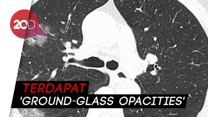 Peneliti Rilis Gambar Paru-paru Pasien Terinfeksi Virus Corona COVID-19