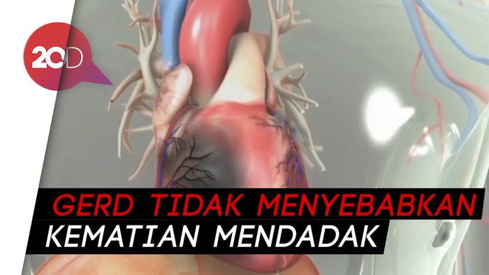 Mengenal Gejala GERD yang Dikaitkan dengan Serangan Jantung