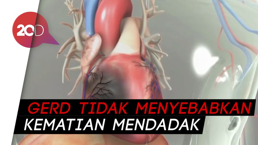 Mengenal Gejala GERD yang Dikaitkan dengan Serangan Jantung
