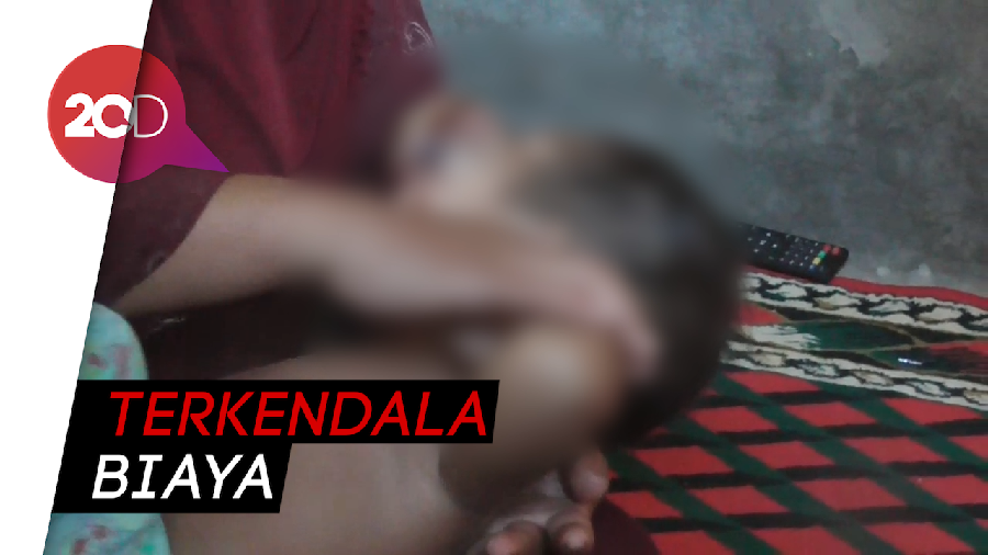 Tolong! Bayi di Polman Derita Tumor Ganas di Mata