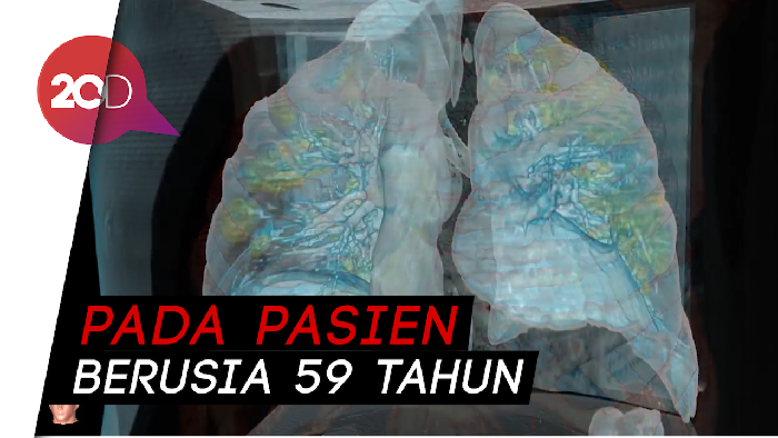 Ini Penampakan Paru-paru yang Terserang COVID-19