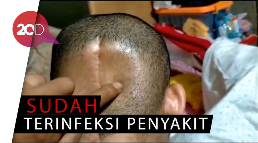 Karena Kanker Otak, Sebagian Tempurung Kepala Istri Reza Dibuang