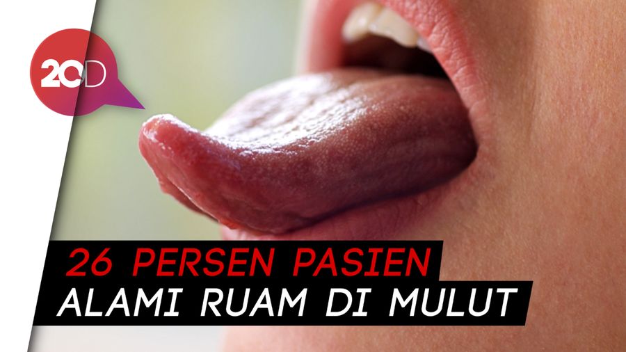 Satu Lagi Gejala Baru Corona: Lidah Ada Benjolan