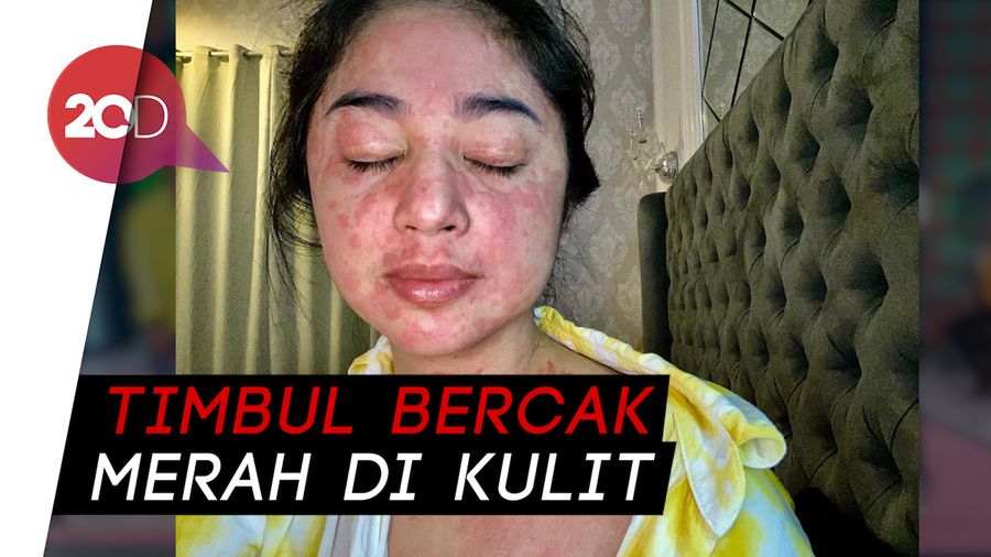 Jarang Muncul di TV, Dewi Perssik Terpapar COVID-19