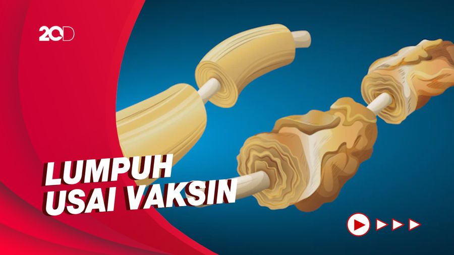 Kenali Guillain Barre Syndrome yang Menimpa Guru Susan