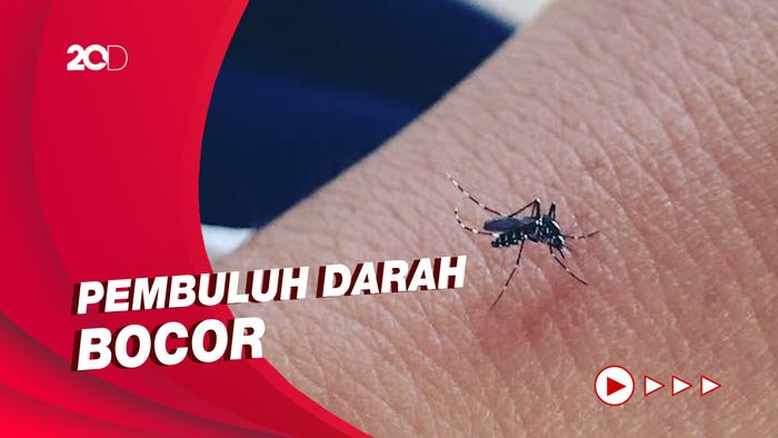 Demam Turun Jadi Fase Kritis saat Alami DBD