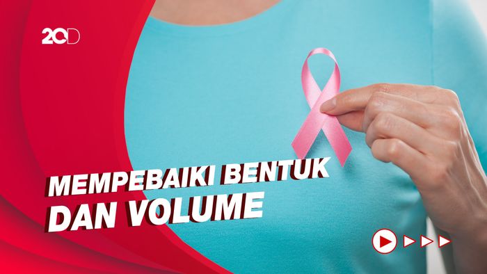 Mengenal Rekonstruksi Payudara untuk Penyintas Kanker