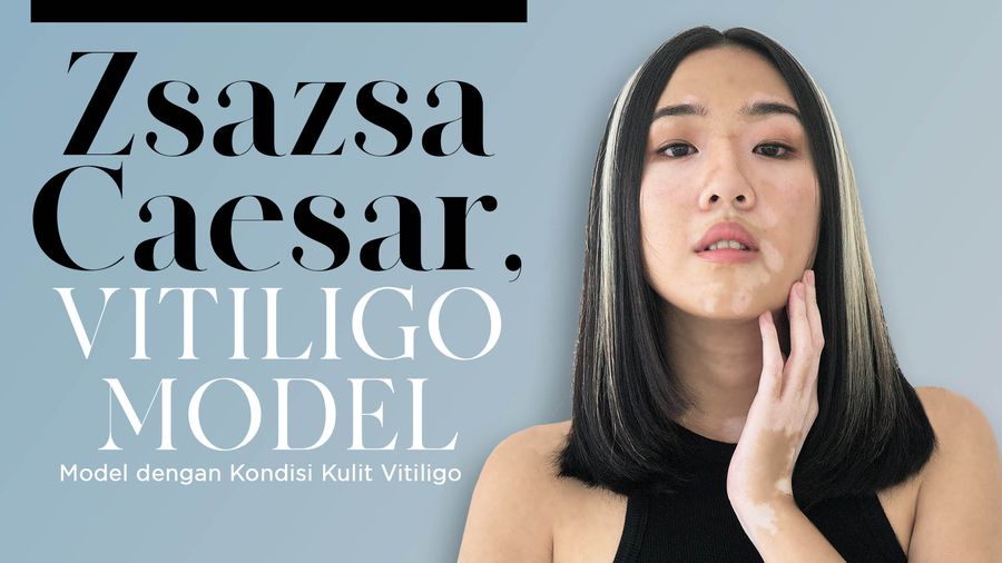 Zsazsa Caesar, Model Asal Bandung dengan Kondisi Kulit Vitiligo