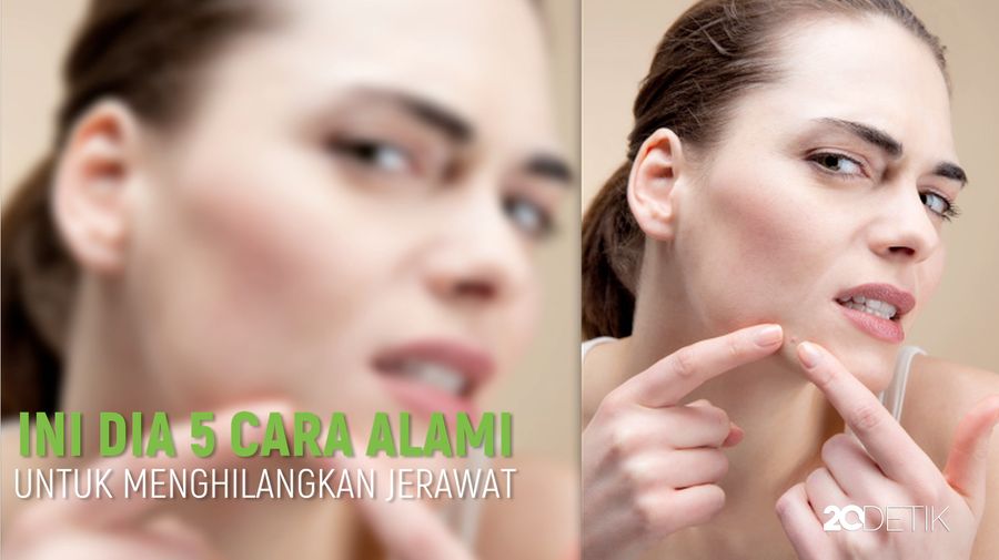 Ini Dia 5 Cara Alami Hilangkan Jerawat
