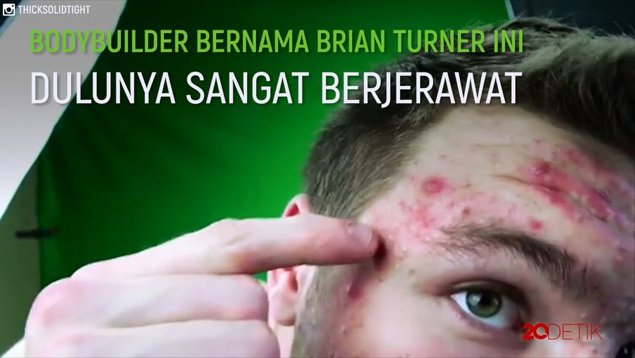 Tips Atasi Jerawat dari Pria yang Dulu Berjerawat Parah