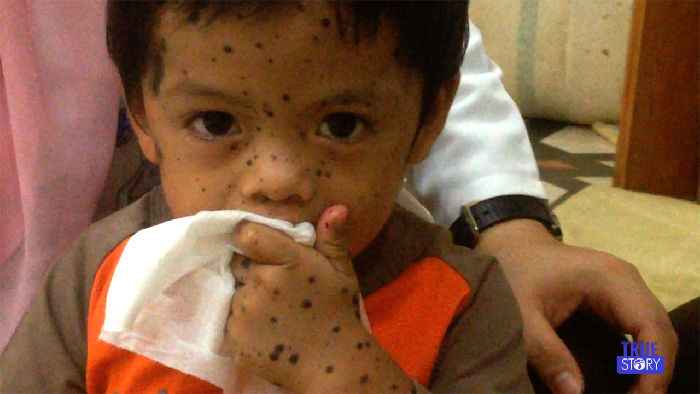 Ghaidan Tetap Lincah Walau Mengidap Penyakit Nevus Langka