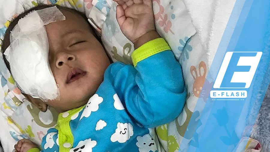 Kenali Penyebab Penyakit Katarak pada Bayi